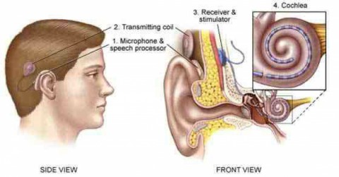 Cochlear Implant